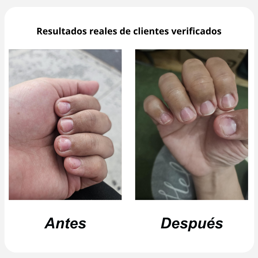 FungaClear Antifungal Pen™