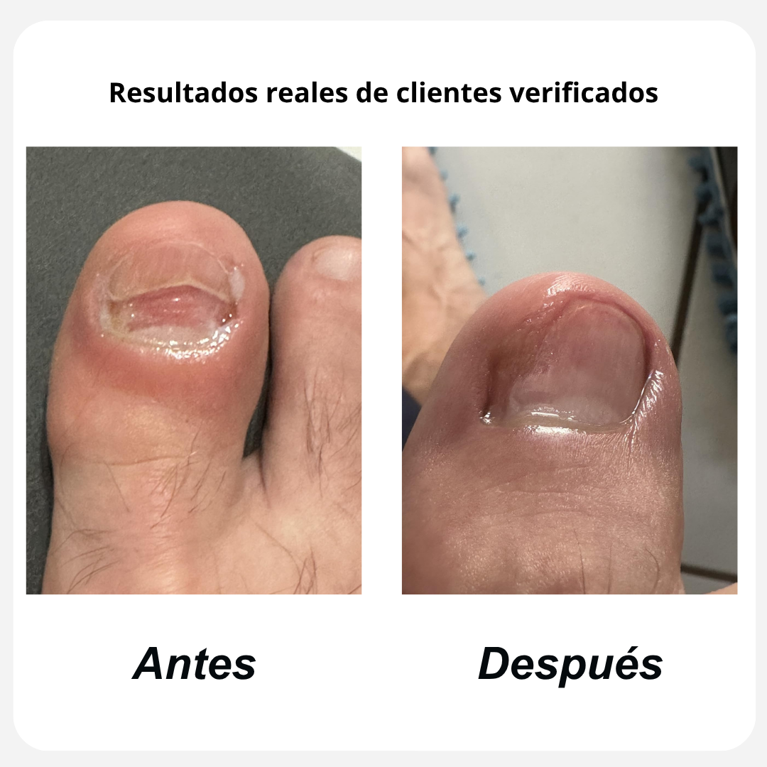 FungaClear Antifungal Pen™